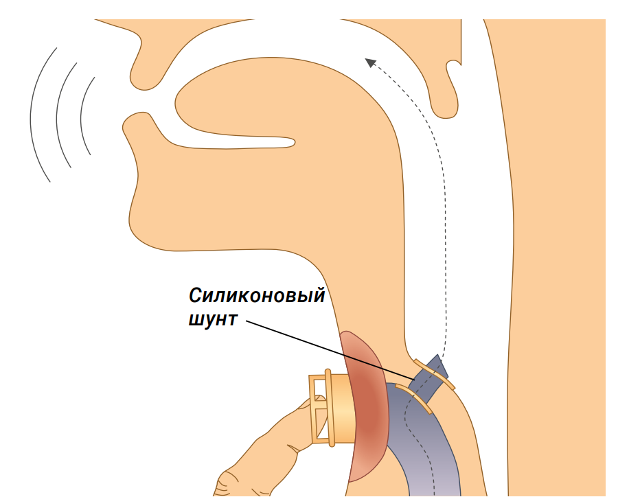 Силиконовый шунт в гортани